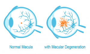 what-is-age-related-macular-degeneration-2