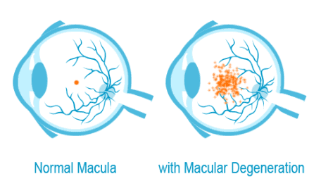 What-is-age-related-macular-degeneration-2
