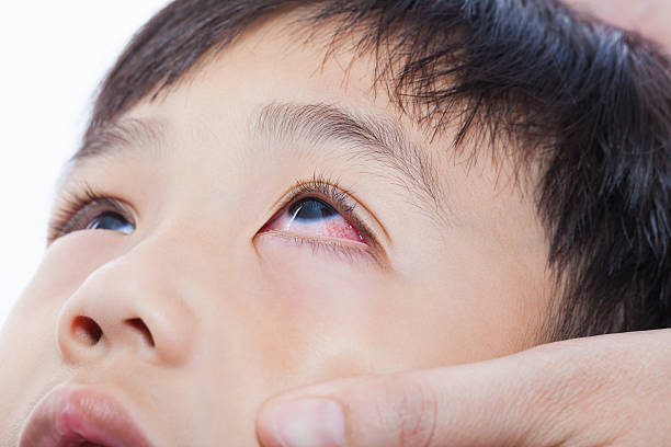 Closeup pinkeye (conjunctivitis) infection on a little asian (thai) boy, mother check up eye her son
