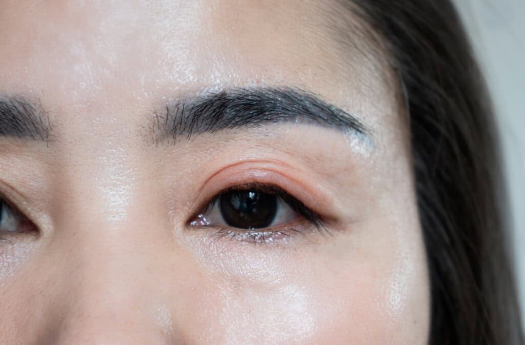 woman with blepharitis