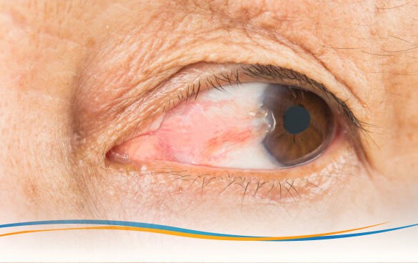 Pterygium
